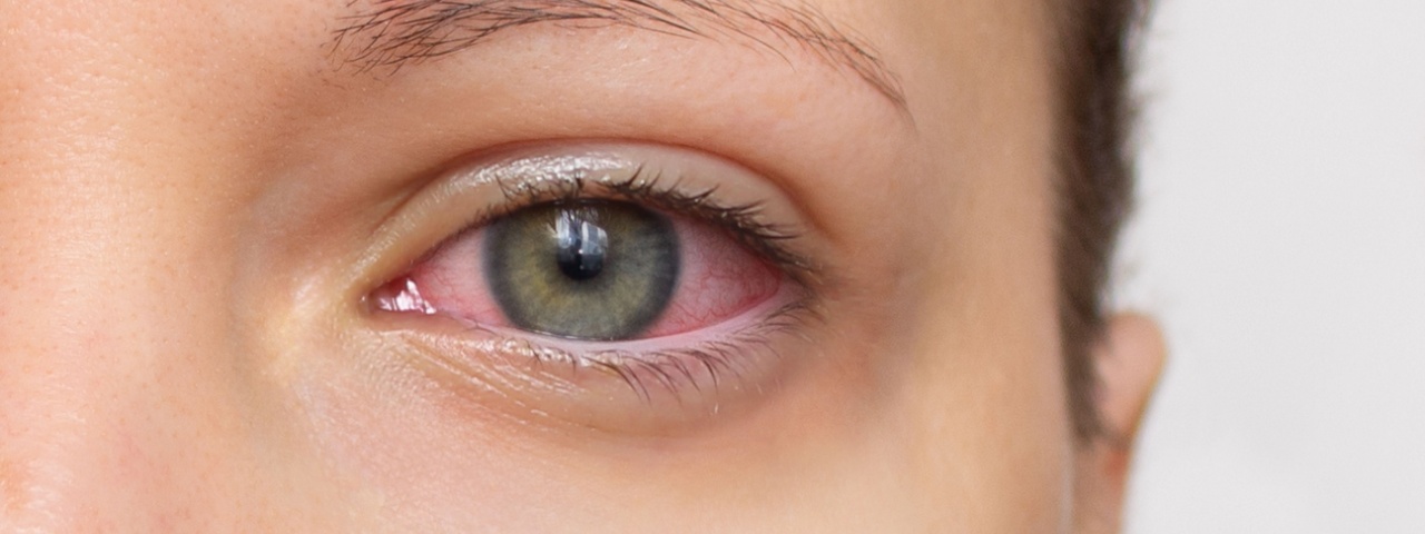 Dry eye